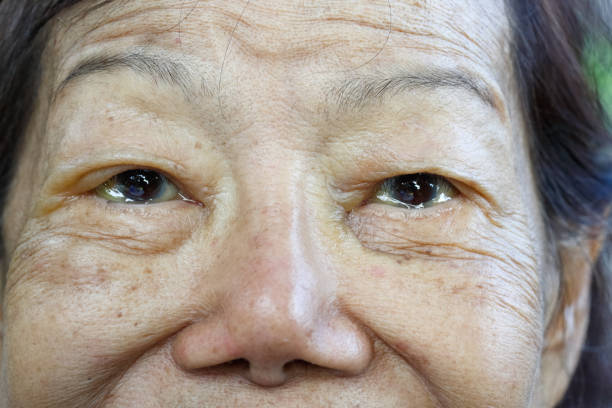 istock eye edema in elderly woman 1173706152