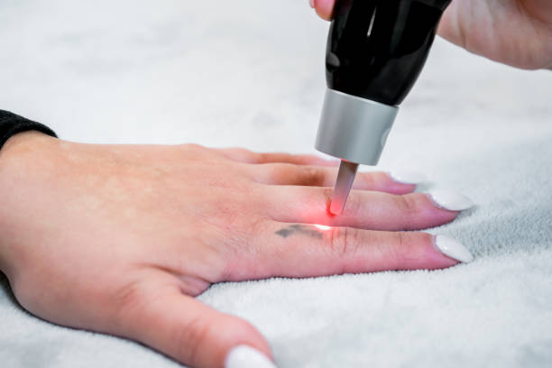 picosecond tatouage laser sur un petit tatouage noir sur le doigt d'un patient, dans une clinique de soins de la peau, avec une esthéticienne administrant les impulsions laser. - administering photos et images de collection