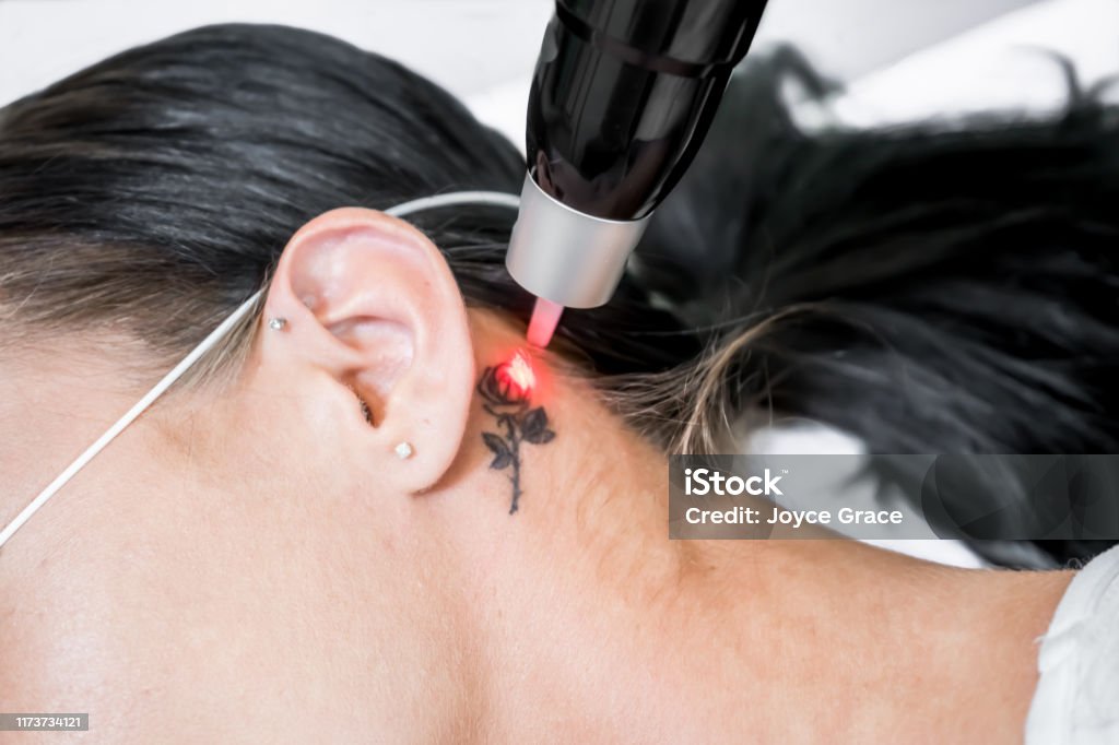 Laser tattoo removal treatment session on patient, using picosecond technology, to break down tattoo ink into smaller particles. At a beauty and skincare clinic for aesthetic lasers. Tattoo Stock Photo