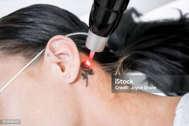 Laser Tattoo Removal Treatment Session On Patient Using Picosecond Technology To Break Down Tattoo Ink Into Smaller Particles At A Beauty And Skincare Clinic For Aesthetic Lasers Stock Photo - Download Image Now