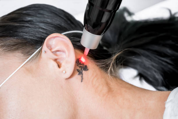 laser tattoo removal treatment session on patient, using picosecond technology, to break down tattoo ink into smaller particles. at a beauty and skincare clinic for aesthetic lasers. - removing imagens e fotografias de stock