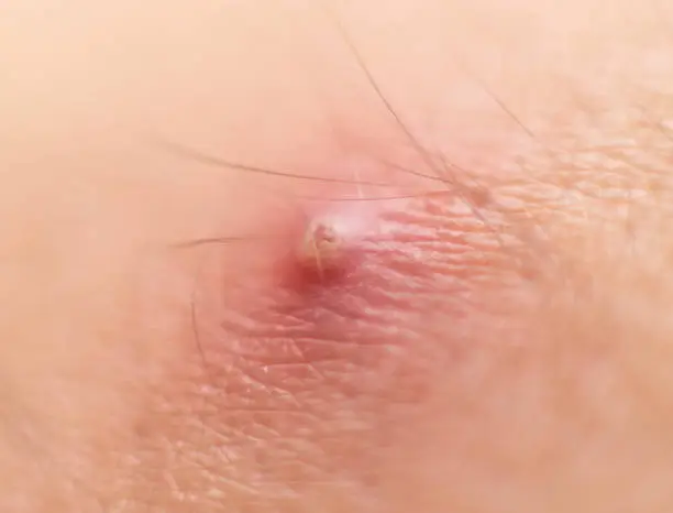 Big red boiling pimple furuncle on the skin, macro, inflamed boil, dermatology, annoying