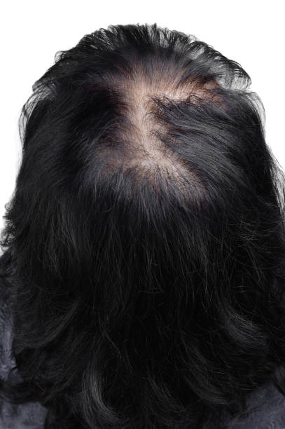 女性の髪は、髪を厚くするために化粧品の粉末を使用した後。前の写真。 - bald patch ストックフォトと画像