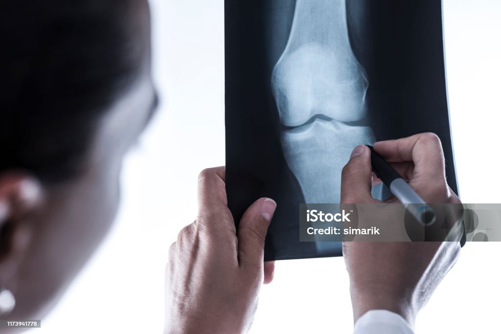 X-Ray of Knee Over the shoulder view of an unrecognizable doctor who is holding and examining a X-Ray of knee. X-ray Image Stock Photo