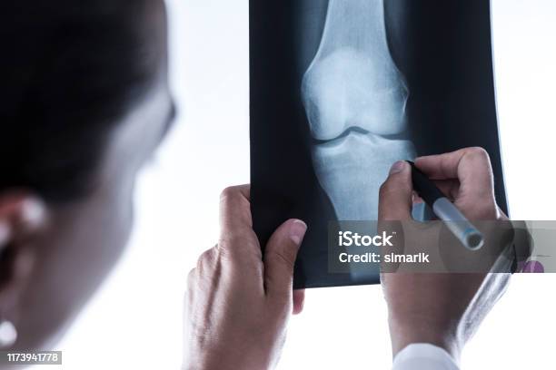 Xray Of Knee Stock Photo - Download Image Now - X-ray Image, Doctor, Orthopedist