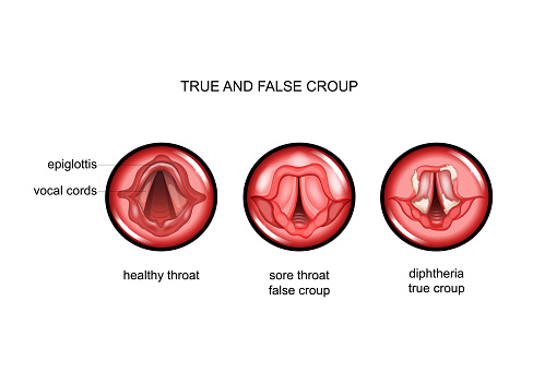 vector illustration of diphtheria. true and false croup