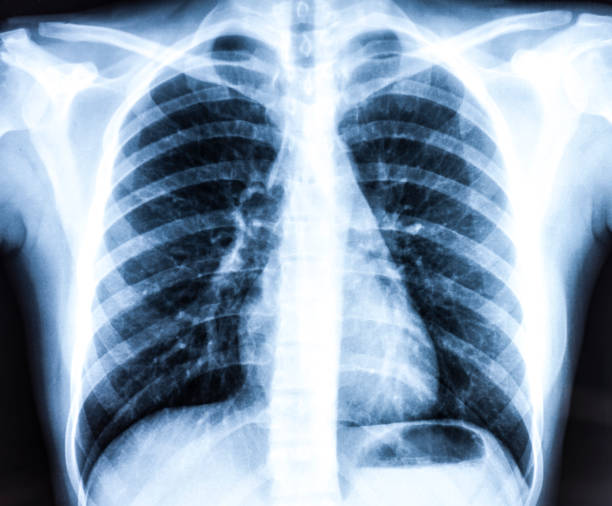 istock X-Ray of Chest 1174095480