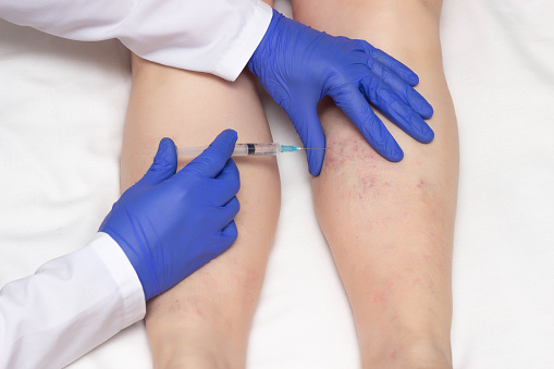El médico con guantes médicos inyecta el procedimiento de escleroterapia en las piernas de una mujer contra las venas varicosas, primer plano, ozonoterapia, photo