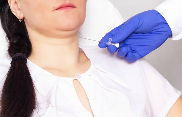istock The doctor makes the patient double chin thread lifting with absorbable threads, cosmetology, thread lifting 1174127277
