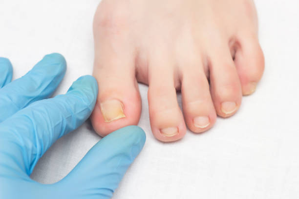 arzt untersucht eingewachsenen nagel auf weibliches bein, onychocryptosis, nahaufnahme, weißer hintergrund, medizinisch, krankheit - fungus toenail human foot onychomycosis stock-fotos und bilder