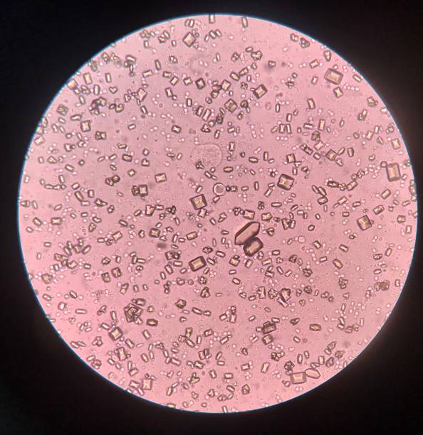 los hallazgos de análisis de orina con microscopio muestran bacterias de cristal de fosfato tripple y levadura en ciernes. - liquid crystal display fotografías e imágenes de stock