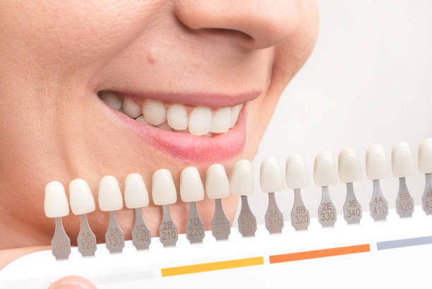 istock Woman smile with healthy teeth whitening 1174414130