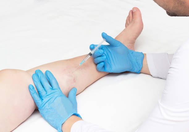 Doctor performs sclerotherapy for varicose veins on the legs, varicose vein treatment, copy space, injection Doctor performs sclerotherapy for varicose veins on the legs, varicose vein treatment, copy space human leg stock pictures, royalty-free photos & images