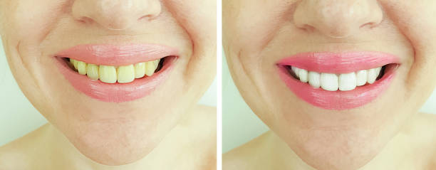 istock woman teeth before and after whitening 1174475258