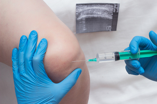 A doctor injects a medical injection of chondroprotector and hyaluronic acid into the knee of a woman to restore the knee joint, cartilage and synovial fluid, close-up, arthrosis