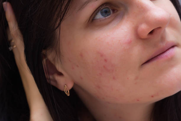 verticale d'une fille brune avec l'acné sur son visage, boutons rouges sur le visage d'une jeune fille, plan rapproché, caucasien - close up human eye photography color image photos et images de collection