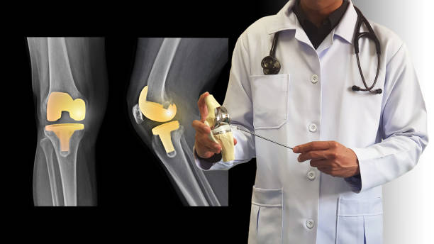 Orthopedic doctor giving information on treatment osteoarthritis disease (OA knee) by surgery with Total Knee Replacement(TKR) prosthesis. Film X ray show joint implant. Medical technology concept. Knee replacement surgery artificial knee photos stock pictures, royalty-free photos & images