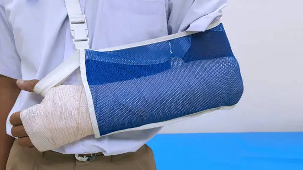 Photo of Patient 's broken bone treatment by orthopedic arm cast and arm sling. Plaster cast and slab is device used to immobilize, stabilize and support fracture.  Medical stabilizer and equipment concept