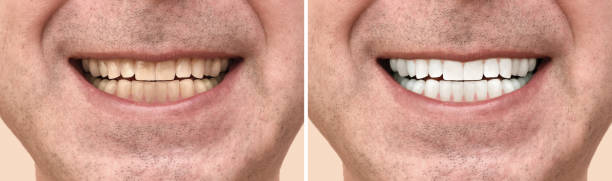 istock Teeth of a man before and after dental treatment 1174586200