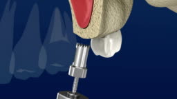 Sinus Lift Surgery Sinus Augmentation 3d Animation Stock Video - Download Video Clip Now - iStock Sinus Lift Surgery Sinus Augmentation 3d Animation Stock Video - Download Video Clip Now - iStock