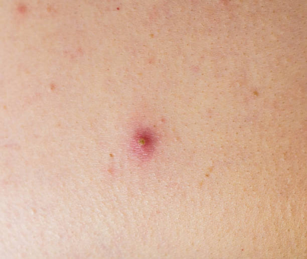 istock Red pimple on face macro, abscess and acne 1174599968