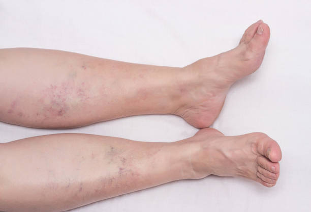 여성의 다리에 정맥류, 흰색 배경, 다리와 하부 다리의 종아리에 정맥류, 정맥, 환자 - insufficiency 뉴스 사진 이미지
