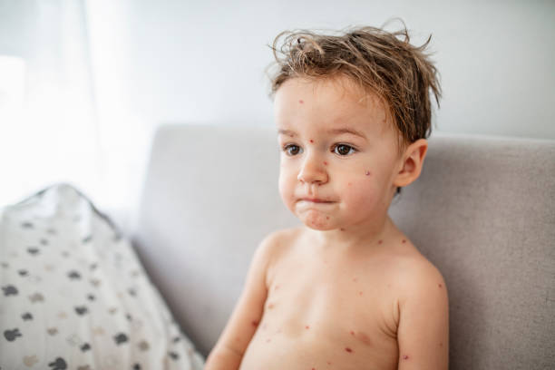 istock Young toddler with chickenpox 1174658403