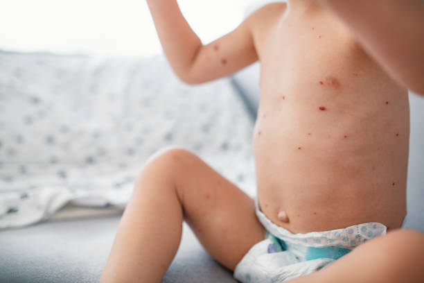 istock Varicella virus or Chickenpox bubble rash on child 1174658902