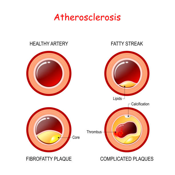 stages of atherosclerosis. Cholesterol in artery. stages of atherosclerosis. Cholesterol in artery. Healthy artery and Developing of plaque from fatty streak to Calcification and thrombosis. cardiovascular disease and ,health risk. Human anatomy atherosclerosis stock illustrations