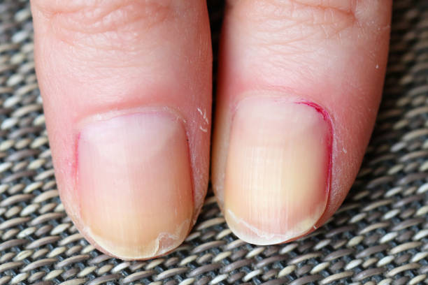 fractionnement et épluchage des ongles - fragilité photos et images de collection