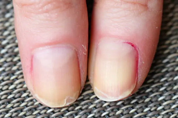Photo of Splitting and peeling nails