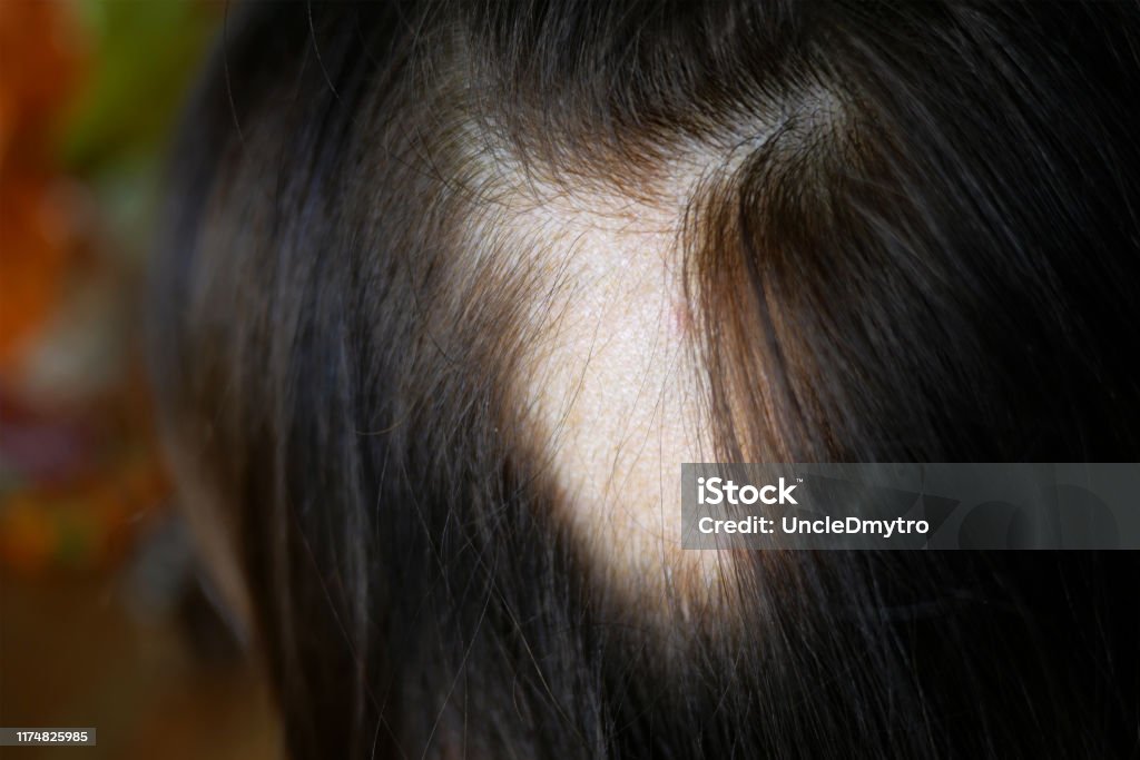 Woman hair loss. Head of woman on part of skin of which there is no hair. Maybe this is alopecia areata, lichen, trichopetia, microsporia. Woman hair loss. Head of woman on part of skin of which there is no hair. Maybe this is alopecia areata, lichen, trichopetia, microsporia. Close-up Balding Stock Photo