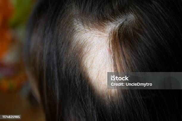 Woman Hair Loss Head Of Woman On Part Of Skin Of Which There Is No Hair Maybe This Is Alopecia Areata Lichen Trichopetia Microsporia Stock Photo - Download Image Now