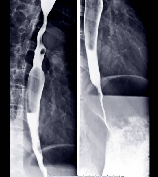 istock Barium swallow AP view Compare after patient drinking a liquid that contains barium showing esophagus. 1174836605