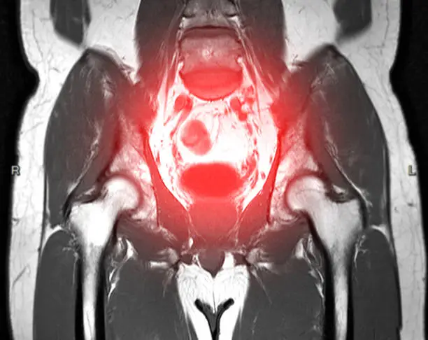 Photo of MRI Lower abdomen Coronal plane T2 Technique for finding myoma uteri.