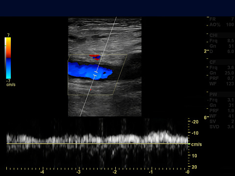 Ultrasound Doppler of femoral vein for finding  deep vein thrombosis or DVT.