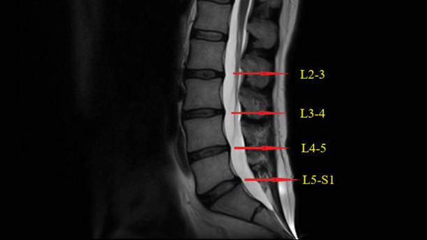 lumbar spine mrt (magnetresonanz) lower back pain imaging - lumbar vertebra stock-fotos und bilder