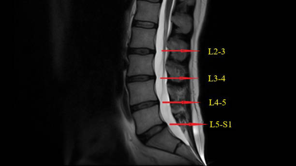 мрт поясничного отдела позвоночника (магнитный резонанс) нижняя часть спины боль в спине imaging - vertebral body стоковые фото и изображения