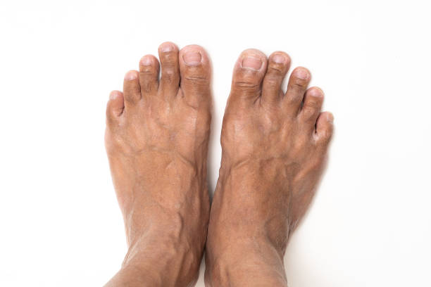 istock Asian man foot brown and dry skin 1175019366