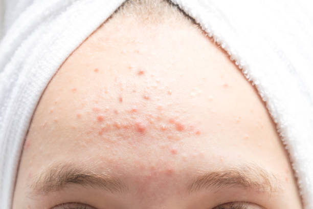 istock teenage acne on the forehead front view close-up 1175052252