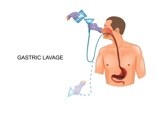 płukanie żołądka z rurką żołądkową - gaster stock illustrations