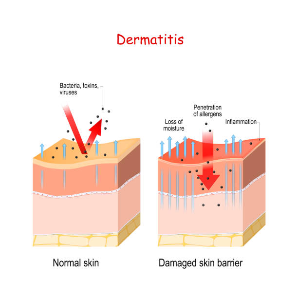 Dermatitis. Normal and skin with Damaged barrier. protection effect Dermatitis. Normal and skin with Damaged barrier. protection effect. The difference between healthy and dry skin skin inflammation stock illustrations