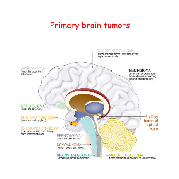 ilustraciones, imágenes clip art, dibujos animados e iconos de stock de cáncer cerebral. diferentes tipos de tumores cerebrales primarios - brain human spine brain stem cerebellum