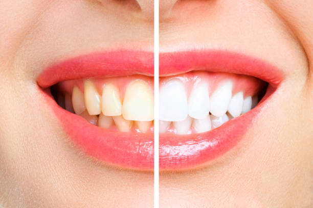 istock woman teeth before and after whitening. Over white background 1175352824