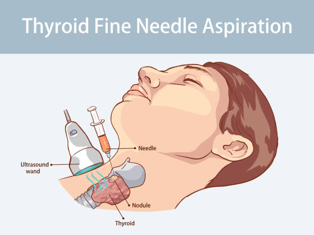 Fine Needle Aspiration of Thyroid Nodules vector art illustration