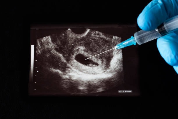 il medico inietta un colpo nella gravidanza uzi, un aborto, una siringa, un guanto, uno sfondo nero - aborto foto e immagini stock