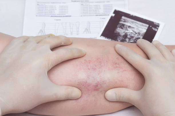 le docteur examine la jambe d'une femme âgée avec des varices sur la jambe et la thrombose, plan rapproché, fond blanc, phlébeurysm - venous insufficiency photos et images de collection