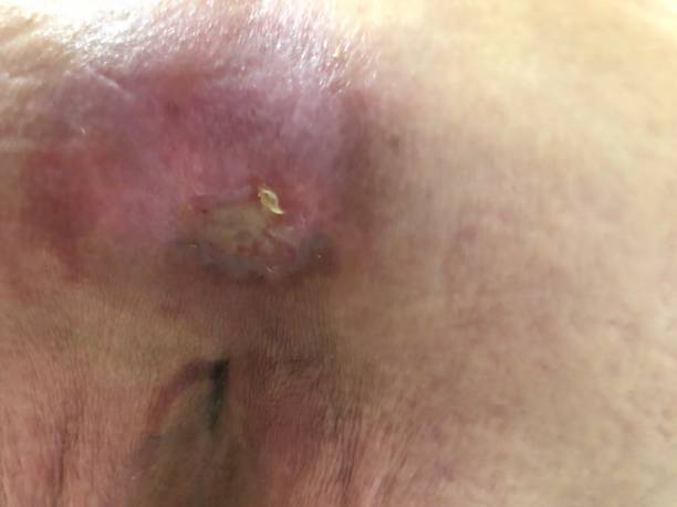 istock Pus filled bedsore on old persons back 1175758358