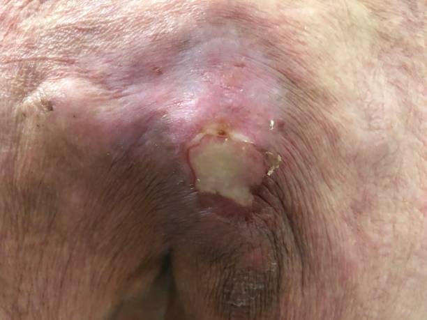 Pus filled bedsore on old persons back Pus filled bed sore on old persons back bed sore stock pictures, royalty-free photos & images
