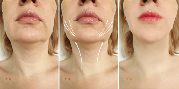istock wrinkles woman face before and after treatment 1175872643